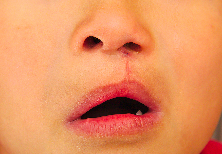 Factores relacionados con la prevalencia de labio y paladar hendido