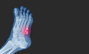Radiografía de las fracturas, algo más que una imagen